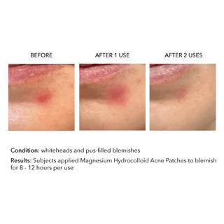 Acne Patches